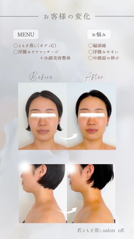 姫路市で片頭痛、浮腫み、中顔面の伸びでお悩みのお客様
